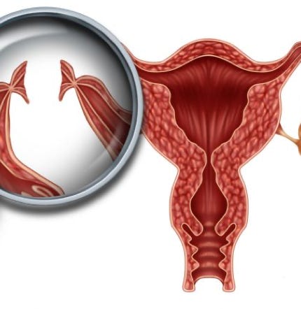 La sterilizzazione tubarica, mediante asportazione di entrambe le tube, come metodo contraccettivo DEFINITIVO per le donne